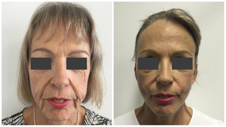 Facelift surgery results 1, Dr Sawhney Gold Coast, front view