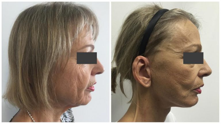Female patient 1 before and after Facelift and neck lift with Dr Sawhney