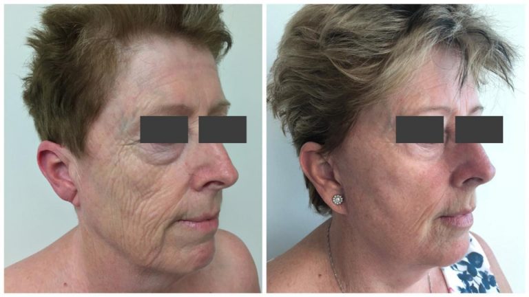 Female patient, facelift results 2, angle view