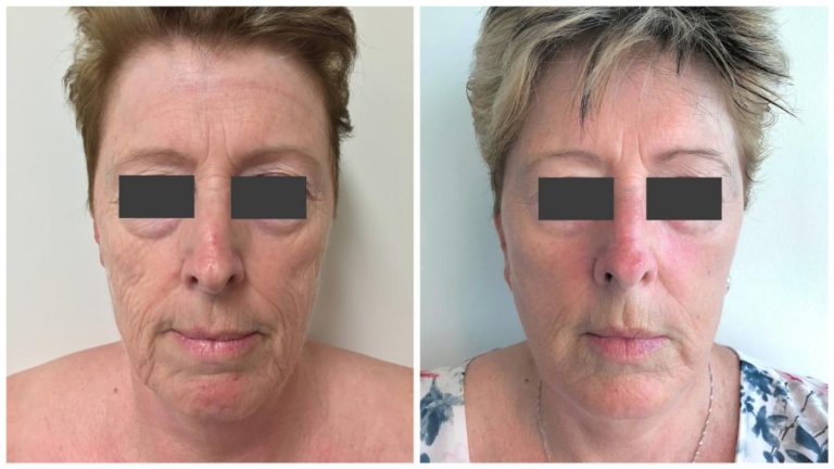 Dr Sawhney Facelift patient 2, before and afters gallery, front view