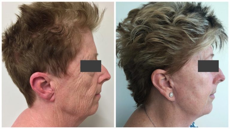 Female patient before and after Facelift 2, right side view