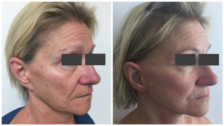 Older female patient before and after Facelift 3, angle view