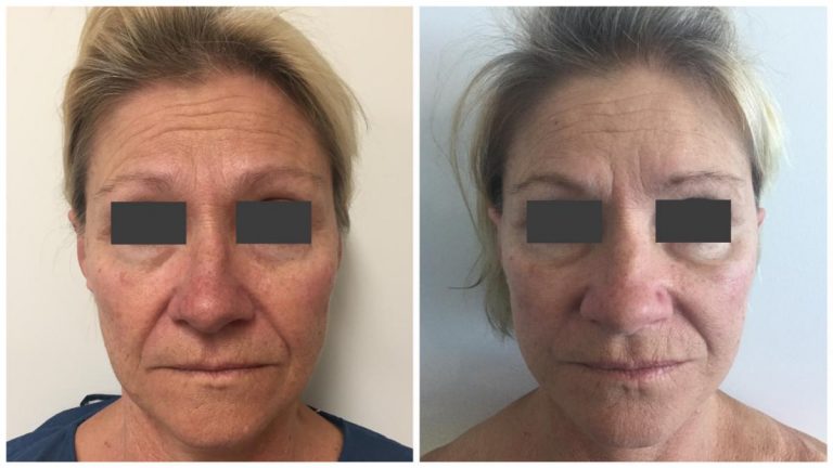 Facelift patient 3, surgery results, front view