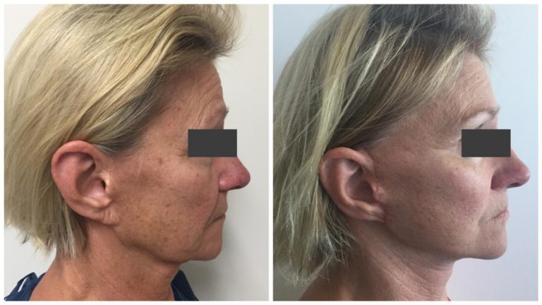 Facelift surgery, results gallery 3, side view, Sculpted Clinic Gold Coast