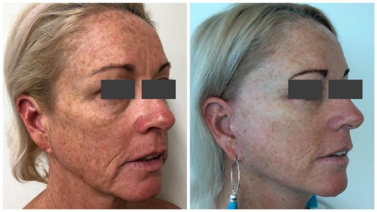 Patient 4 before and after Facelift, angle view
