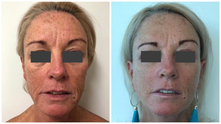 Female patient before and after Facelift 4, front view, Sculpted Clinic Gold Coast