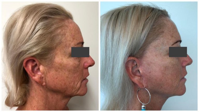 Female Facelift patient 4, before and afters, right side