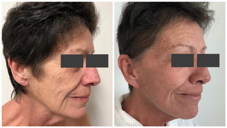 Facelift before ad after 5, angle view, Sculpted Clinic Gold Coast