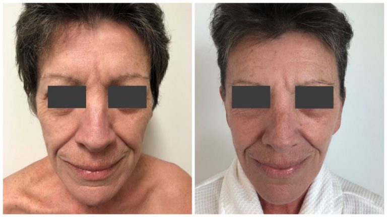 Facelift patient No. 5 before and after the procedure, front view