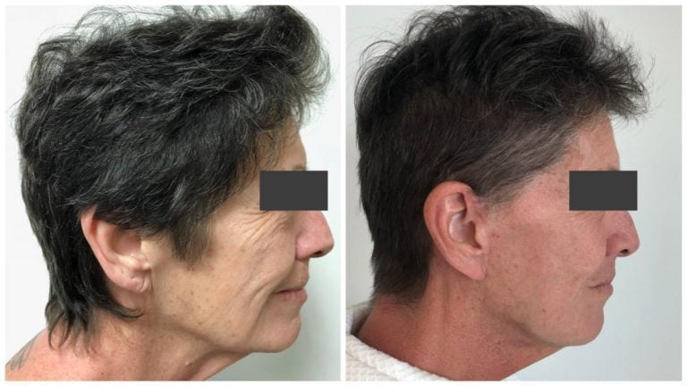 Female facelift patient before and after 5, right side view, Dr Sawhney