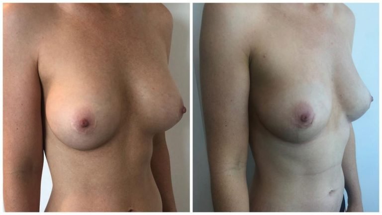 Patient 2 angle view before and after photo, breast implant removal and fat transfer, Dr Sawhney