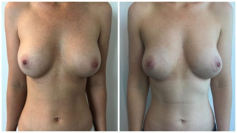 Before and after breast implant removal in combination with breast fat transfer, patient 2 front view