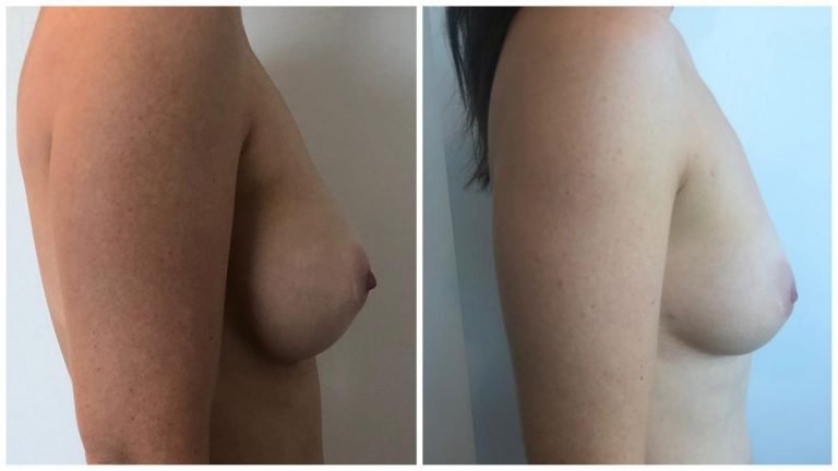 Breast implant removal & AFT, patient 2, side view, Sculpted Clinic