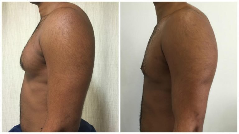Gynaecomastia surgery, male breast reduction patient 1 (left side view), before and after, Dr Sawhney Gold Coast