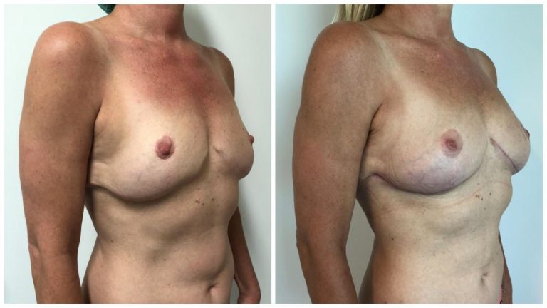 Dr Sawhney, autologous fat transfer,Dr Sawhney, autologous fat transfer, patient 2, angle view, Sculpted Clinic photos patient 2, angle view, Sculpted Clinic photos