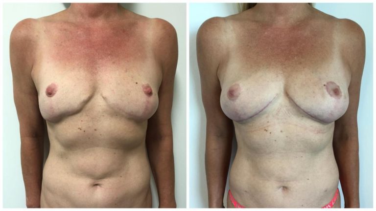 Autologous fat transfer patient 2, front view, Sculpted Clinic photo gallery