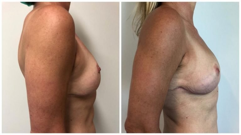 Before and afters, autologous fat transfer, patient 2 side view, Dr Sawhney photo gallery