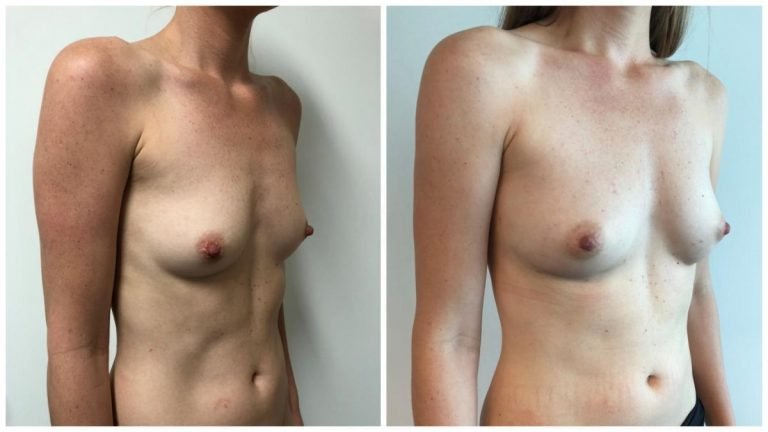 Before & after breast fat transfer (AFT), patient 3 angle, Sculpted Clinic Gold Coast
