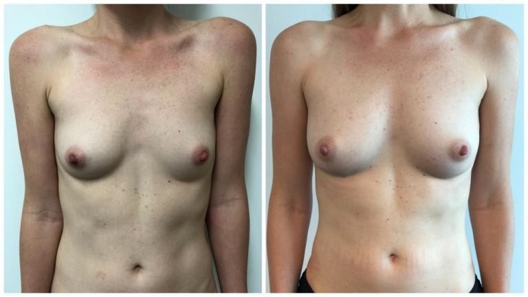 Breast fat transfer (AFT) with Dr Sawhney, patient 3 front