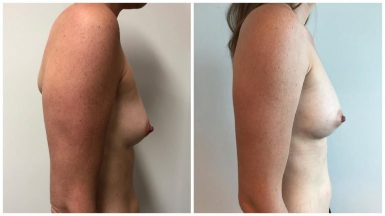 Breast fat transfer surgery before and after (AFT), patient 3 side view, Dr Sawhney Gold Coast