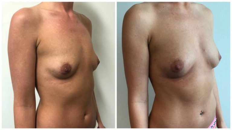 Before and after breast fat transfer, patient 4 angle, Sculpted Clinic Gold Coast