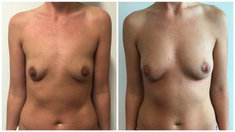 Breast fat transfer patient 4 front, before & after gallery, Dr Sawhney