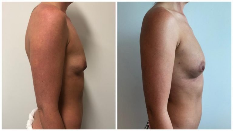 Breast fat transfer (AFT) patient 4 before and after, side view