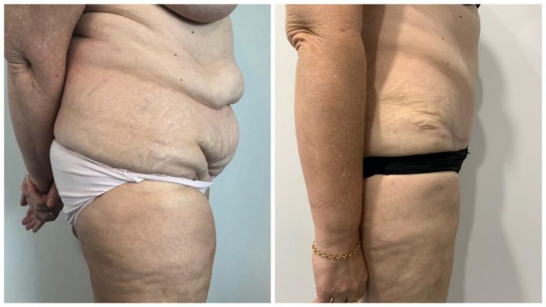 Tummy Tuck Extended Patient 6 Side