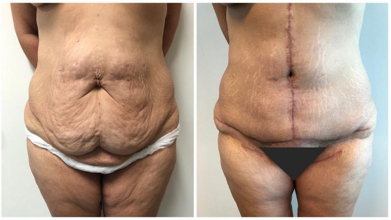 Extended Abdominoplasty, before and afters, patient 7, right side view, Dr Sawhney Gold Coast