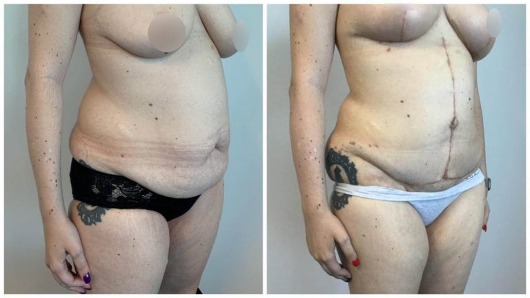 Extended Abdominoplasty, before and after, patient 8, angle view