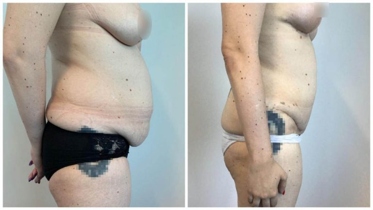 Extended Abdominoplasty, before and after, patient 8, right side view