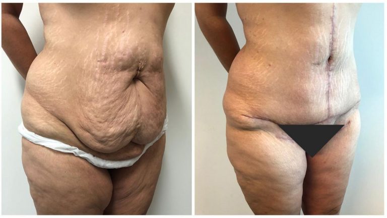 Extended Abdominoplasty, patient 7, before and after surgery results, angle view, Sculpted Clinic