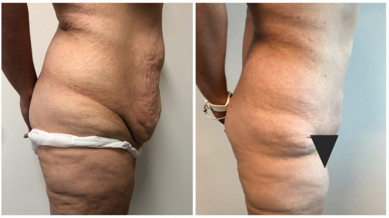 Extended Abdominoplasty, before and afters, patient 7, right side view, Dr Sawhney Gold Coast