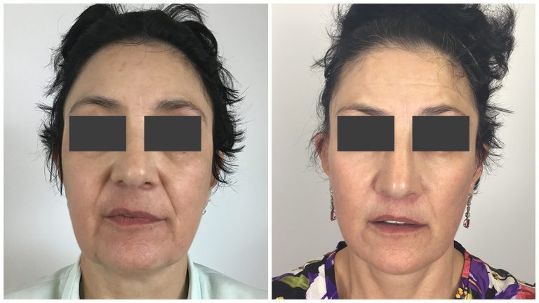 Face and neck lift surgery 3-1, before and afters, Sculpted Clinic