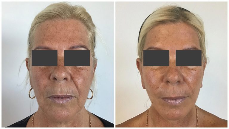 Facelift and neck lift surgery 1-1, Dr Raja Sawhney Gold Coast