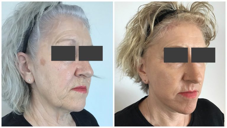 Facelift surgery results 6-2, female patient, Dr Sawhney