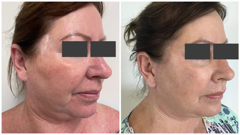Facelift surgery, before and after 5-2, Dr Sawhney Gold Coast