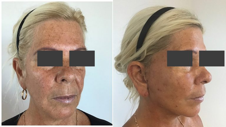 Face and neck lift, before and after 1-2, Dr Sawhney
