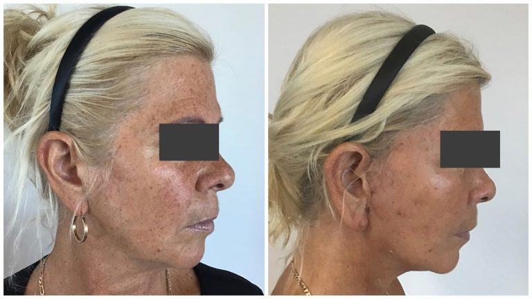 Facelift and neck lift, before and after 1-3, right side view, Sculpted Clinic Gold Coast